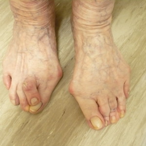 Rheumatoid Feet