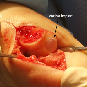 cartiva implant