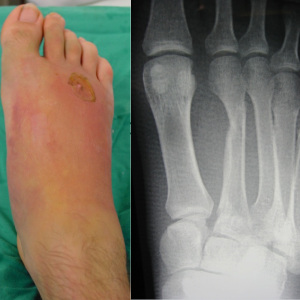 Midfoot Injuries
