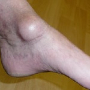 ganglion of the foot or ankle