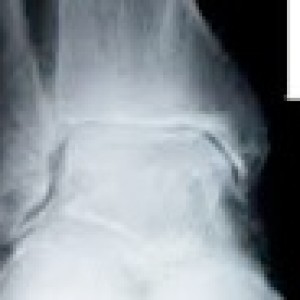 ankle arthritis xray