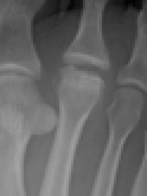 xray x ray of freiburg disease
