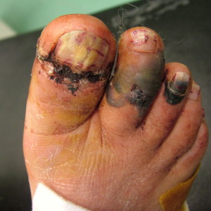 Forefoot Injuries