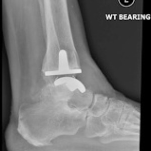 ankle replacement