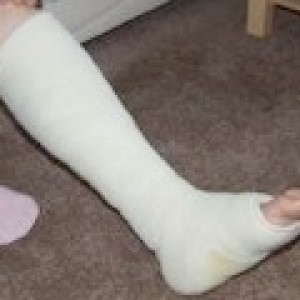 plaster cast flat foot surgery
