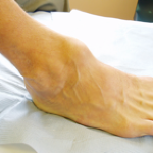 ankle swelling arthritis 