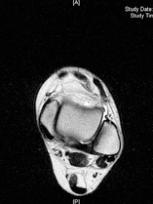 mri scan ankle instability ligament