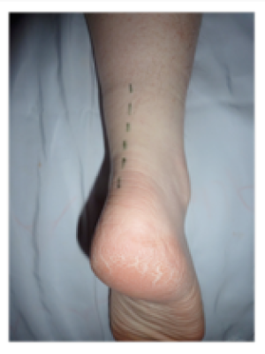 Incision for Achilles tendonitis clean up