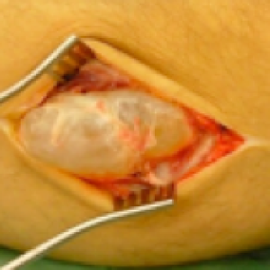 picture of ganglion surgery