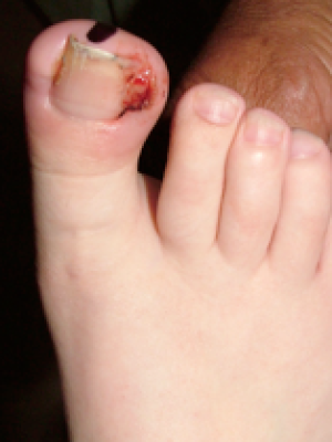 ingrowing toe nail