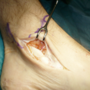 diseased posterior tibial tendon