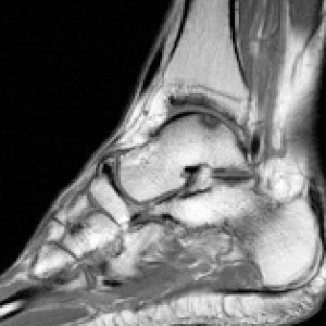 ankle instability pain osteochondral injury