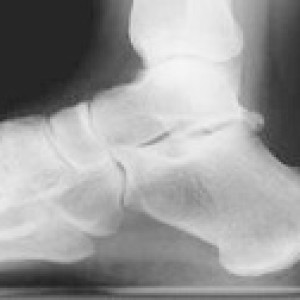 xray x ray of high arched foot