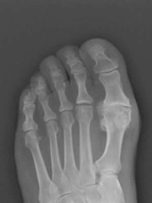 big toe arthritis x ray hallux rigidus xray