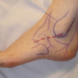 incision for ankle instability brostrum procedure