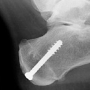 xray x ray after calcaneal osteotomy
