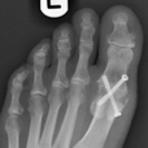 fusion surgery big toe arthritis hallux rigidus