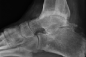 ankle arthritis x-ray