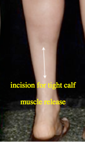 incision for release of gastrocnemius tendon