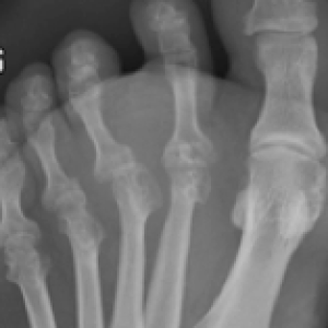 xray x ray of rheumatoid foot