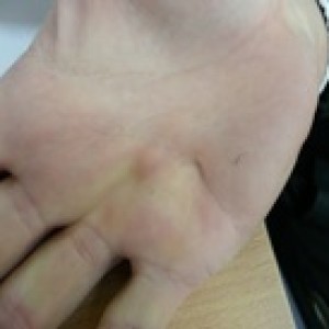 fibroma in the hand dupuytren's disease