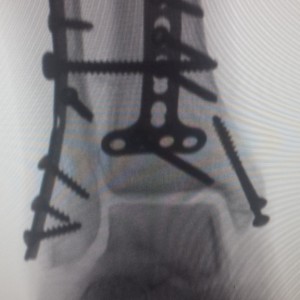 xray of ankle fracture