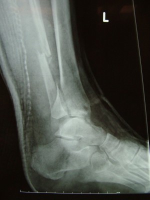 xray ankle fracture x ray